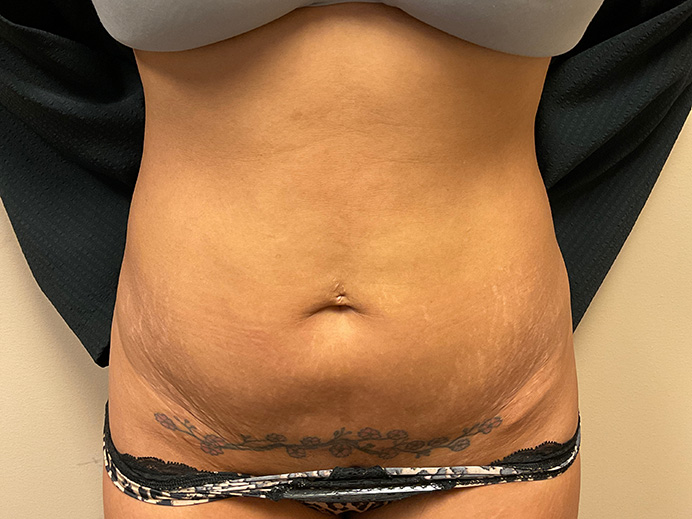 Tummy Tuck Akron Before & After | Patient 15 Photo 0 Thumb