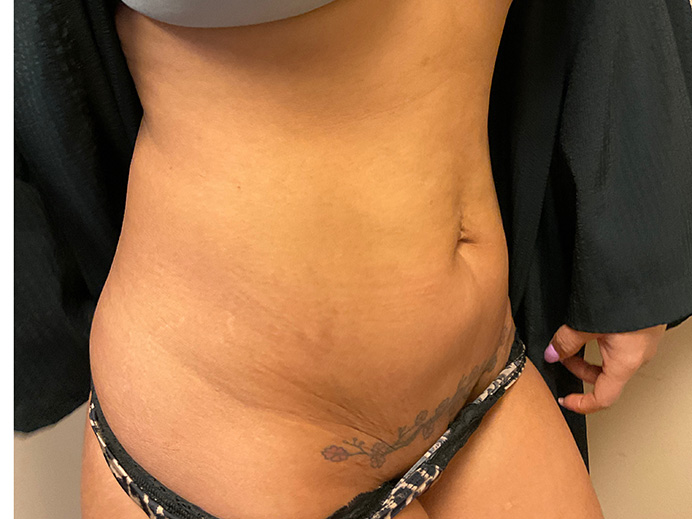 Tummy Tuck Akron Before & After | Patient 15 Photo 2 Thumb
