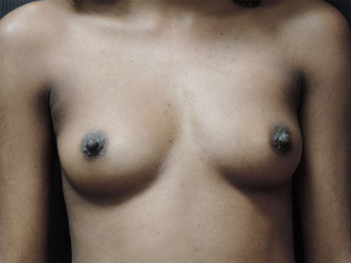 Breast Augmentation Akron Before & After | Patient 01 Photo 0 Thumb