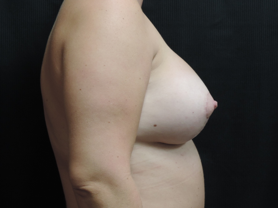 Breast Lift Akron Before & After | Patient 01 Photo 5