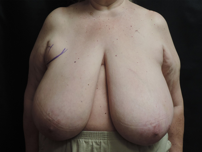 Breast Reduction Akron Before & After | Patient 02 Photo 0