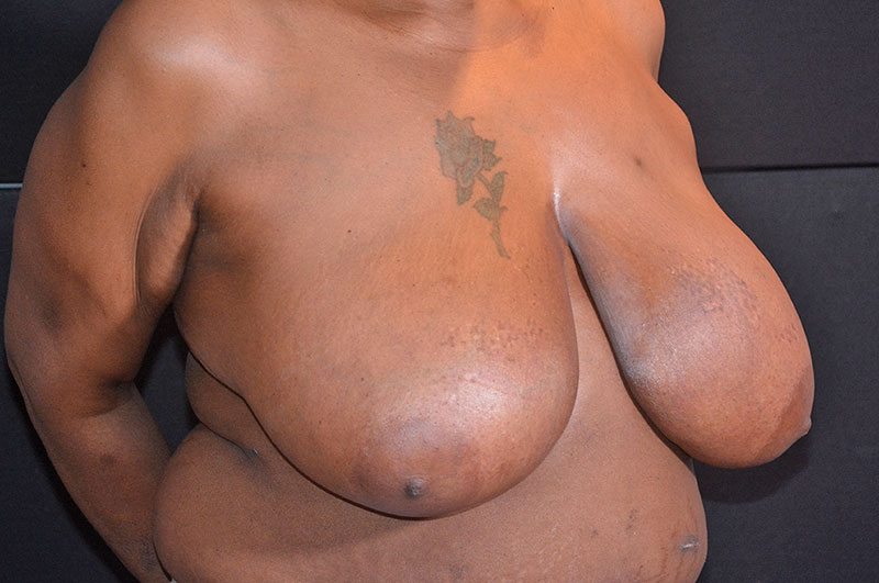 Breast Reduction Akron Before & After | Patient 05 Photo 2 Thumb