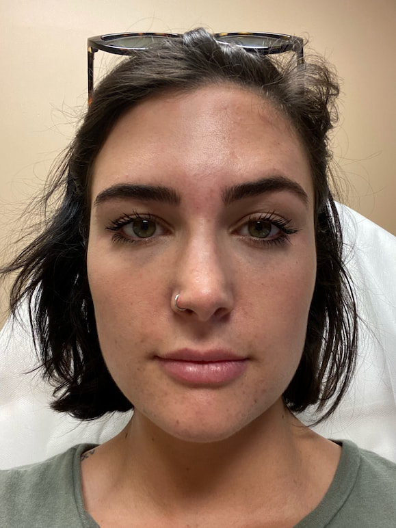 Fillers Akron Before & After | Patient 01 Photo 2 Thumb