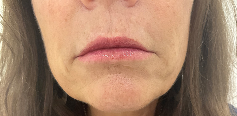 Fillers Akron Before & After | Patient 03 Photo 1